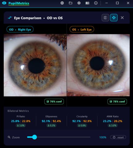 Eye comparison showing both irides side by side with synchronised zoom and a bilateral metrics strip with deltas.