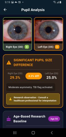 Android results showing a 4.3 percent pupil size difference, moderate asymmetry, TBI flag activated.
