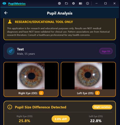 Results screen showing the research-tool disclaimer, patient details, both eye images with confidence grades, and a pupil size difference card reading 25.8 versus 22.8 percent, a 3.0 percent difference.
