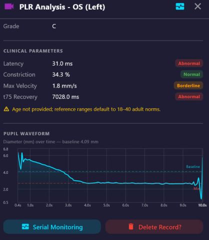 A PLR analysis panel: Grade C, latency 31 ms flagged abnormal, constriction 34.3 percent normal, max velocity 1.8 millimetres per second borderline, t75 recovery 7028 ms abnormal, above a pupil diameter waveform.
