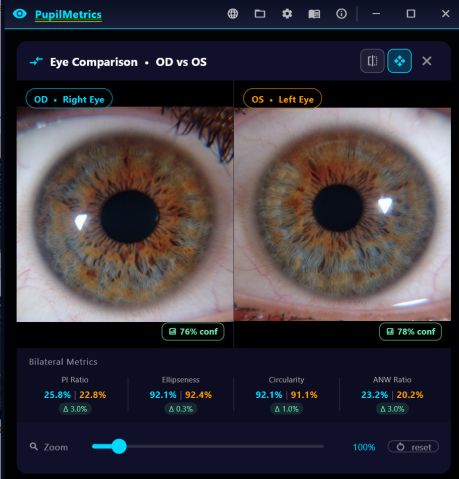 The eye comparison dialog showing right and left irides side by side with synchronised zoom and a bilateral metrics strip beneath.