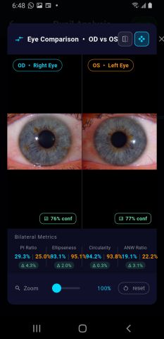 The eye comparison view on Android with both irides and the bilateral metrics strip.