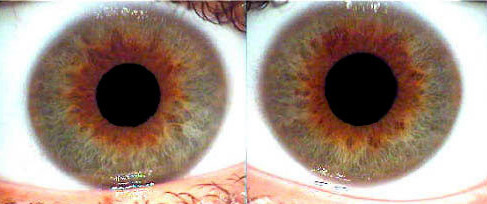 Normal Pupil Color