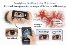 Smartphone pupillometry for detection of cerebral vasospasm after aneurysmal subarachnoid hemorrhage