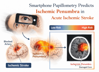 Smartphone pupillometry predicts ischemic penumbra in acute ischemic stroke